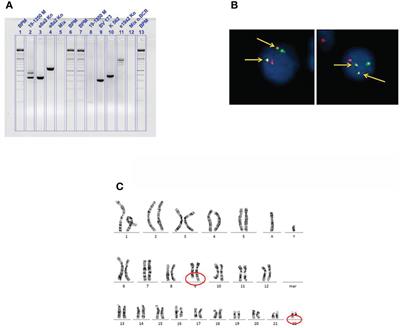 Atypical presentation of patients with chronic myeloid leukemia in chronic phase—Case report